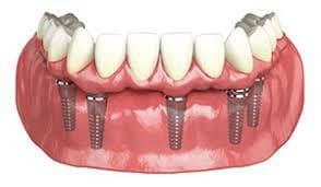 Prótesis dental completa fija sobre implantes de arco completo