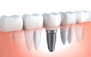 Implante dental único para el reemplazo de un solo diente