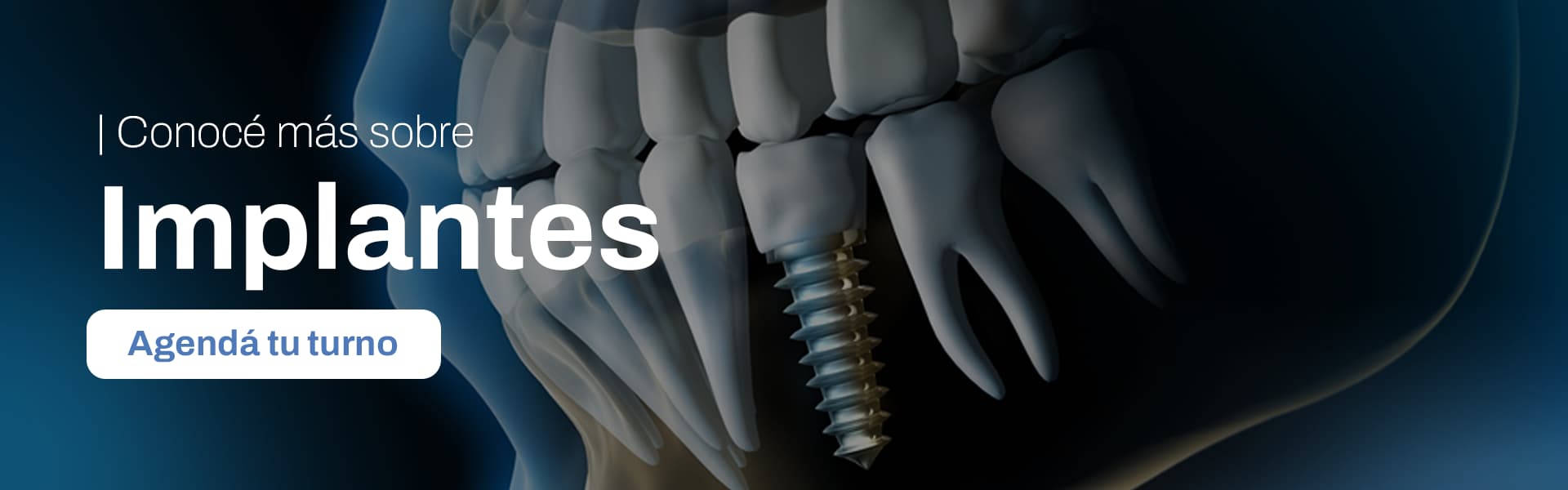 Banner de implantes dentales en Rosario - CM Dental