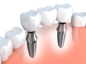 Puente dental apoyado sobre implantes dentales múltiples